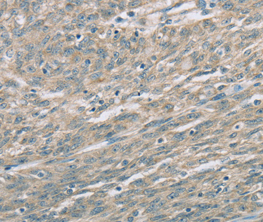 Immunohistochemistry of paraffin-embedded Human esophagus cancer using EDA2R Polyclonal Antibody at dilution of 1:60