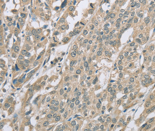 Immunohistochemistry of paraffin-embedded Human ovarian cancer using EDA2R Polyclonal Antibody at dilution of 1:60