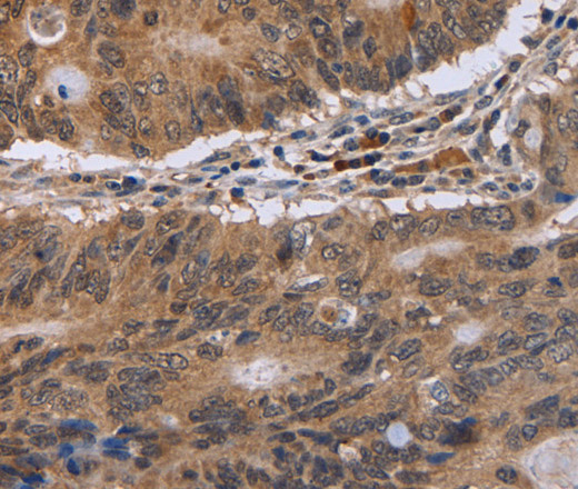 Immunohistochemistry of paraffin-embedded Human colon cancer tissue using EIF3H Polyclonal Antibody at dilution 1:40