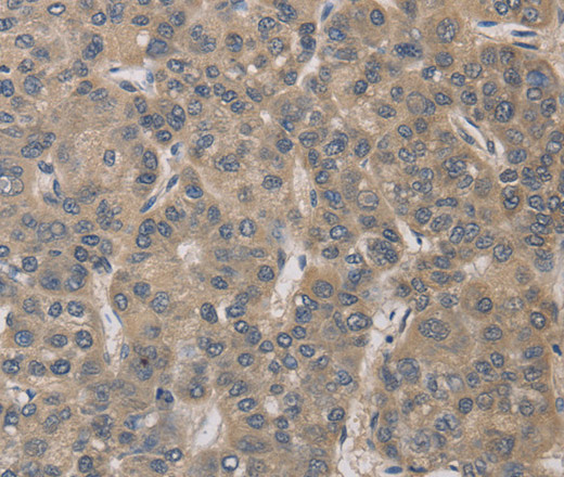 Immunohistochemistry of paraffin-embedded Human liver cancer tissue using ELOVL1 Polyclonal Antibody at dilution 1:30