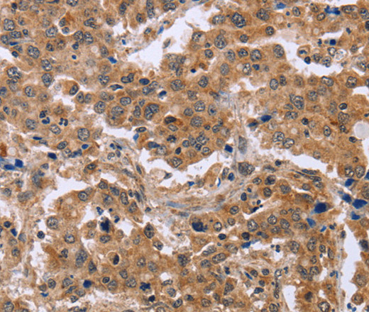 Immunohistochemistry of paraffin-embedded Human liver cancer using EPDR1 Polyclonal Antibody at dilution of 1:40