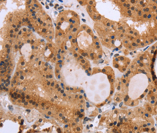 Immunohistochemistry of paraffin-embedded Human thyroid cancer using EPDR1 Polyclonal Antibody at dilution of 1:40