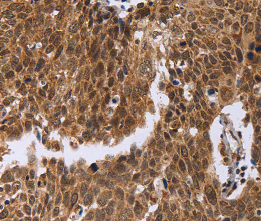 Immunohistochemistry of paraffin-embedded Human cervical cancer tissue using ERCC6L Polyclonal Antibody at dilution 1:30