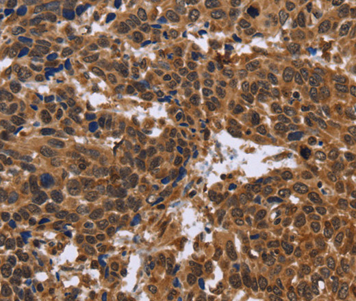 Immunohistochemistry of paraffin-embedded Human cervical cancer using EDN2 Polyclonal Antibody at dilution of 1:30