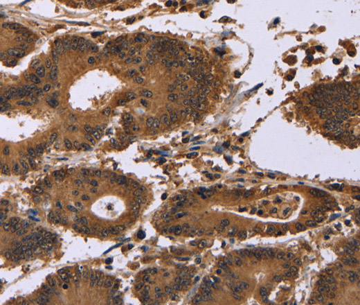 Immunohistochemistry of paraffin-embedded Human colon cancer using EDN2 Polyclonal Antibody at dilution of 1:30