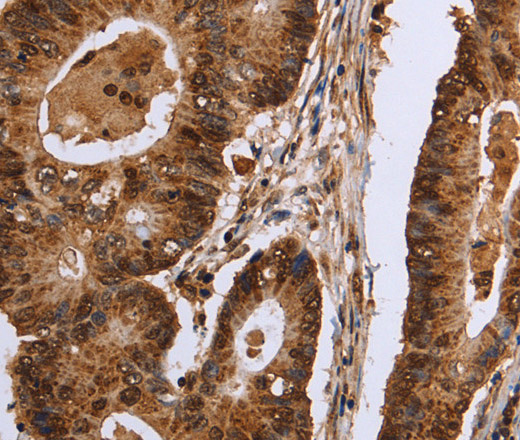 Immunohistochemistry of paraffin-embedded Human colon cancer tissue using EXTL3 Polyclonal Antibody at dilution 1:30