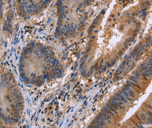 Immunohistochemistry of paraffin-embedded Human colon cancer tissue using FAAH2 Polyclonal Antibody at dilution 1:30