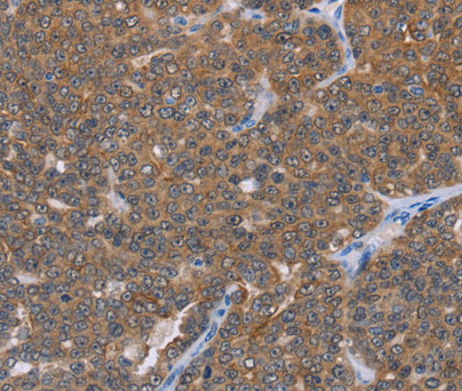 Immunohistochemistry of paraffin-embedded Human ovarian cancer using FABP6 Polyclonal Antibody at dilution of 1:30