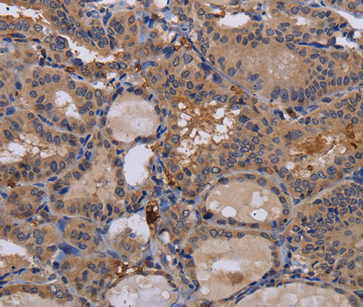 Immunohistochemistry of paraffin-embedded Human thyroid cancer using FADS1 Polyclonal Antibody at dilution of 1:60