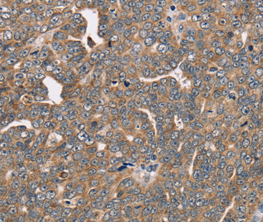 Immunohistochemistry of paraffin-embedded Human cervical cancer tissue using FAIM2 Polyclonal Antibody at dilution 1:40