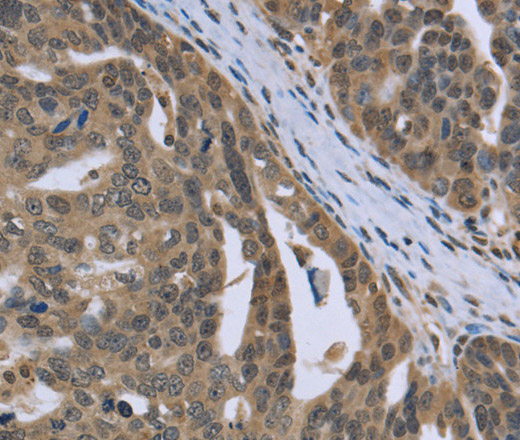 Immunohistochemistry of paraffin-embedded Human ovarian cancer tissue using PTK2B Polyclonal Antibody at dilution 1:30