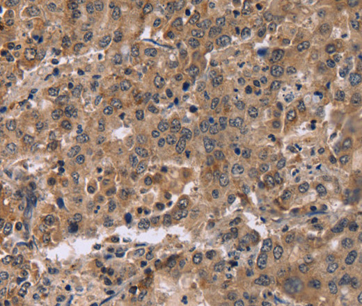 Immunohistochemistry of paraffin-embedded Human liver cancer tissue using FAM107A Polyclonal Antibody at dilution 1:30