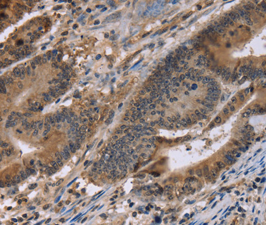 Immunohistochemistry of paraffin-embedded Human colon cancer tissue using FAM107A Polyclonal Antibody at dilution 1:30