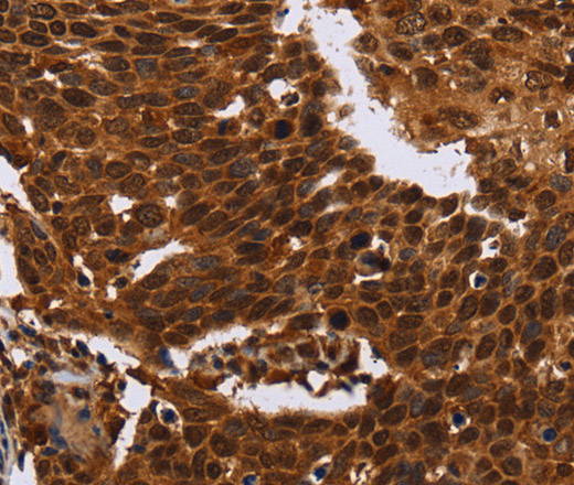 Immunohistochemistry of paraffin-embedded Human cervical cancer tissue using FANCF Polyclonal Antibody at dilution 1:60