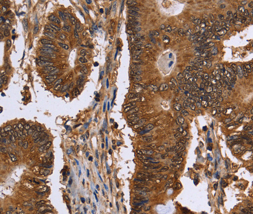 Immunohistochemistry of paraffin-embedded Human colon cancer tissue using FANCF Polyclonal Antibody at dilution 1:60