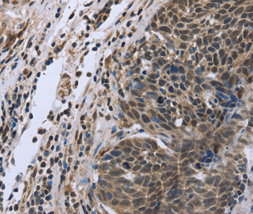 Immunohistochemistry of paraffin-embedded Human cervical cancer tissue using FANCG Polyclonal Antibody at dilution 1:50