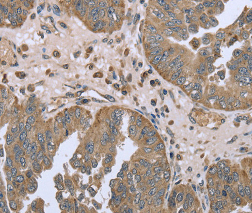 Immunohistochemistry of paraffin-embedded Human ovarian cancer tissue using FANCG Polyclonal Antibody at dilution 1:50