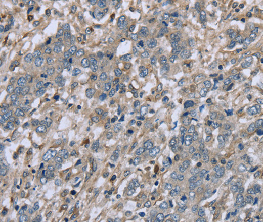 Immunohistochemistry of paraffin-embedded Human liver cancer tissue using FAP Polyclonal Antibody at dilution 1:30