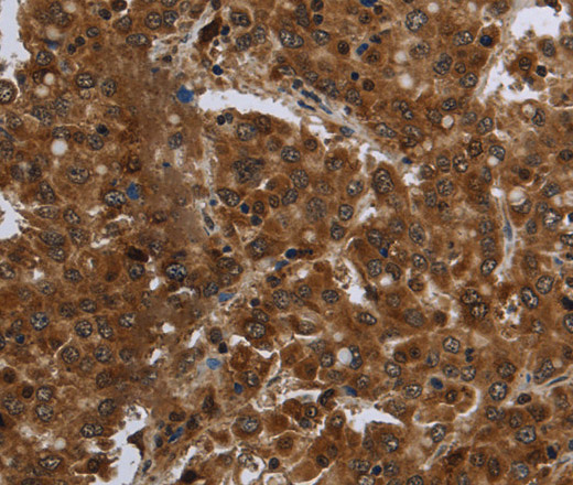 Immunohistochemistry of paraffin-embedded Human liver cancer tissue using FASTKD1 Polyclonal Antibody at dilution 1:60