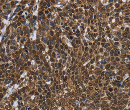 Immunohistochemistry of paraffin-embedded Human cervical cancer tissue using FASTKD2 Polyclonal Antibody at dilution 1:50