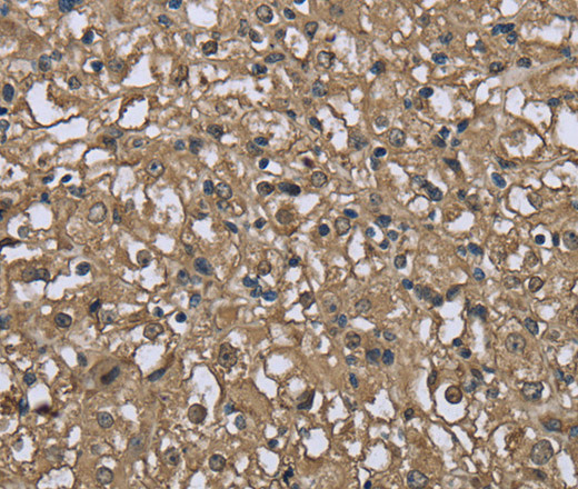 Immunohistochemistry of paraffin-embedded Human prostate cancer using FBP1 Polyclonal Antibody at dilution of 1:40