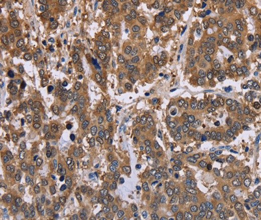 Immunohistochemistry of paraffin-embedded Human liver cancer tissue using FBP2 Polyclonal Antibody at dilution 1:40