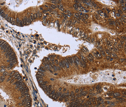 Immunohistochemistry of paraffin-embedded Human colon cancer tissue using FGFR1OP Polyclonal Antibody at dilution 1:50