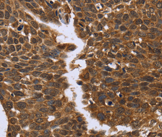 Immunohistochemistry of paraffin-embedded Human cervical cancer tissue using FGFR1OP Polyclonal Antibody at dilution 1:50