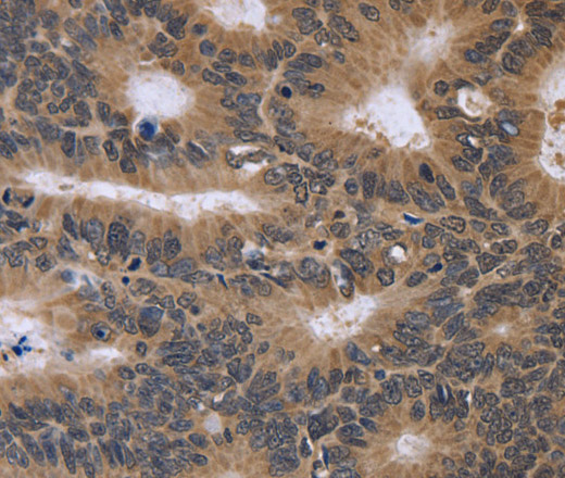 Immunohistochemistry of paraffin-embedded Human colon cancer tissue using FGFR1OP2 Polyclonal Antibody at dilution 1:40