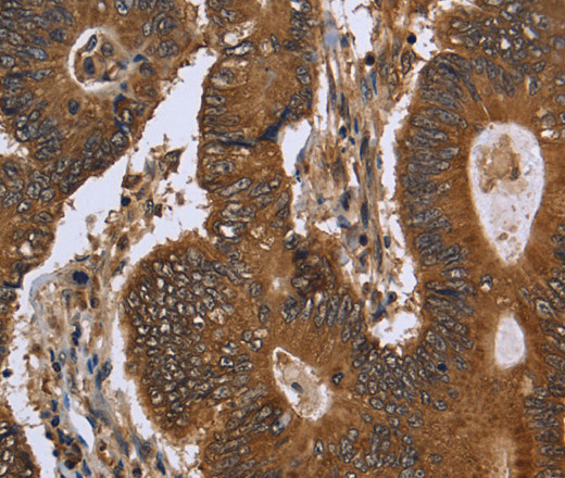 Immunohistochemistry of paraffin-embedded Human colon cancer using FGFRL1 Polyclonal Antibody at dilution of 1:40