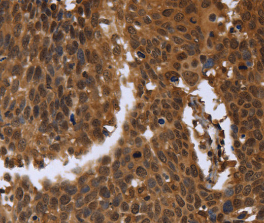 Immunohistochemistry of paraffin-embedded Human cervical cancer using FGFRL1 Polyclonal Antibody at dilution of 1:40