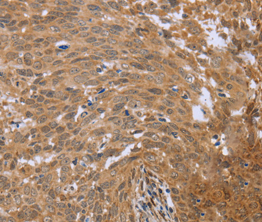 Immunohistochemistry of paraffin-embedded Human cervical cancer using FHL2 Polyclonal Antibody at dilution of 1:40