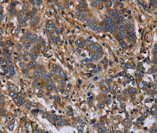 Immunohistochemistry of paraffin-embedded Human liver cancer using FLNA Polyclonal Antibody at dilution of 1:40