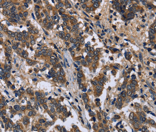 Immunohistochemistry of paraffin-embedded Human liver cancer using FRK Polyclonal Antibody at dilution of 1:50