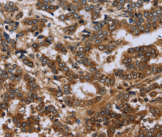 Immunohistochemistry of paraffin-embedded Human liver cancer using FH Polyclonal Antibody at dilution of 1:30