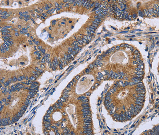 Immunohistochemistry of paraffin-embedded Human colon cancer using GABPB2 Polyclonal Antibody at dilution of 1:30