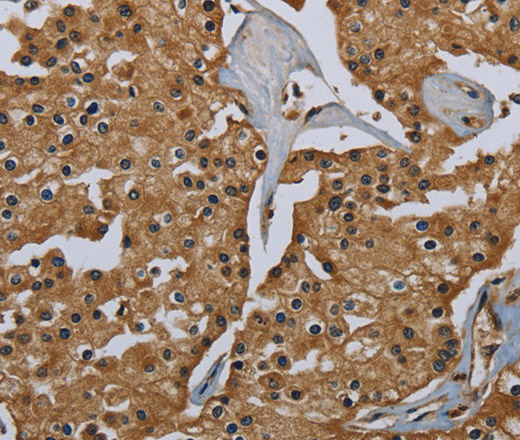 Immunohistochemistry of paraffin-embedded Human prostate cancer tissue using GBP5 Polyclonal Antibody at dilution 1:40