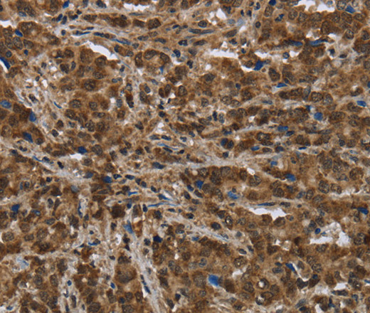 Immunohistochemistry of paraffin-embedded Human liver cancer tissue using PIP Polyclonal Antibody at dilution 1:50