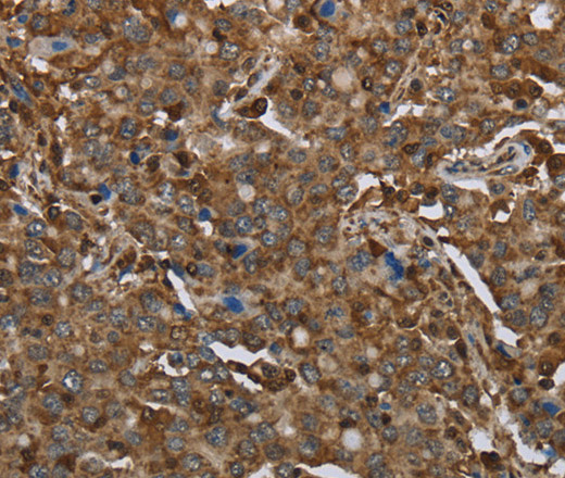 Immunohistochemistry of paraffin-embedded Human liver cancer using ARHGDIA Polyclonal Antibody at dilution of 1:30