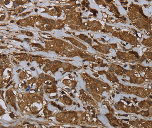 Immunohistochemistry of paraffin-embedded Human breast cancer using ARHGDIA Polyclonal Antibody at dilution of 1:30