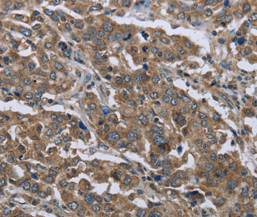 Immunohistochemistry of paraffin-embedded Human liver cancer using GGCX Polyclonal Antibody at dilution of 1:50