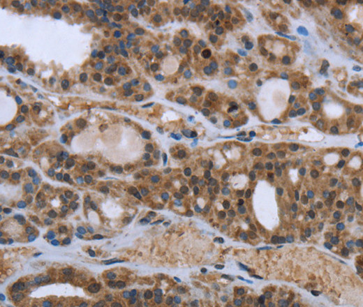 Immunohistochemistry of paraffin-embedded Human thyroid cancer using GGCX Polyclonal Antibody at dilution of 1:50