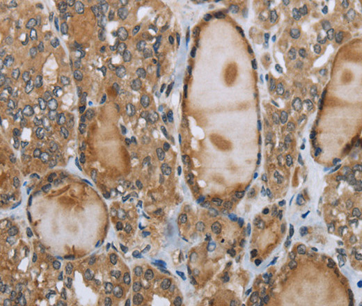 Immunohistochemistry of paraffin-embedded Human thyroid cancer using GGT1 Polyclonal Antibody at dilution of 1:40