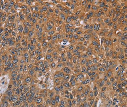 Immunohistochemistry of paraffin-embedded Human lung cancer using GH2 Polyclonal Antibody at dilution of 1:40