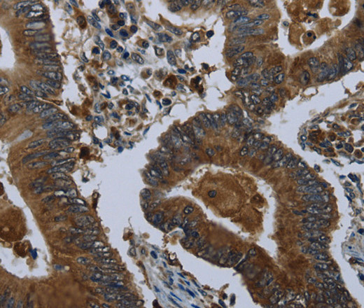 Immunohistochemistry of paraffin-embedded Human colon cancer using GLUL Polyclonal Antibody at dilution of 1:60