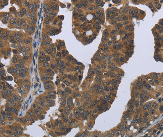 Immunohistochemistry of paraffin-embedded Human ovarian cancer tissue using GYS2 Polyclonal Antibody at dilution 1:50