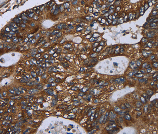 Immunohistochemistry of paraffin-embedded Human colon cancer using GOLGA2 Polyclonal Antibody at dilution of 1:60