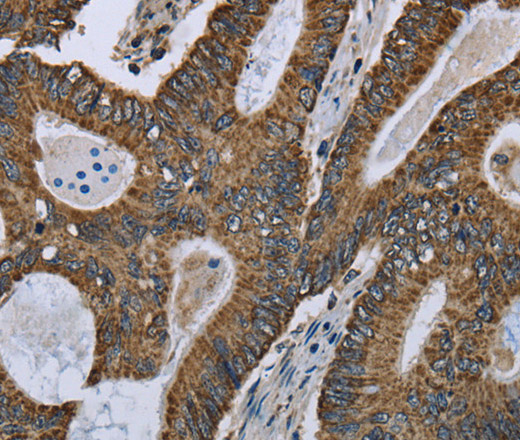 Immunohistochemistry of paraffin-embedded Human colon cancer using GOT2 Polyclonal Antibody at dilution of 1:50