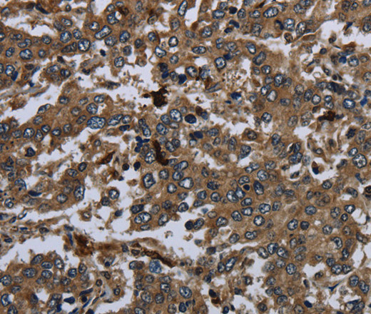 Immunohistochemistry of paraffin-embedded Human liver cancer using CD42b Polyclonal Antibody at dilution of 1:60