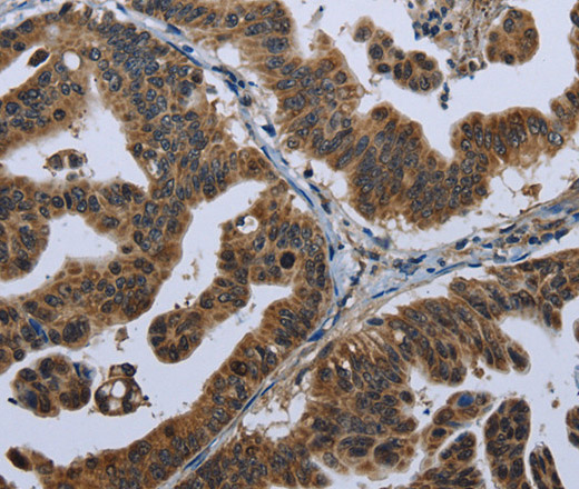 Immunohistochemistry of paraffin-embedded Human gastric cancer tissue using GPAM Polyclonal Antibody at dilution 1:60